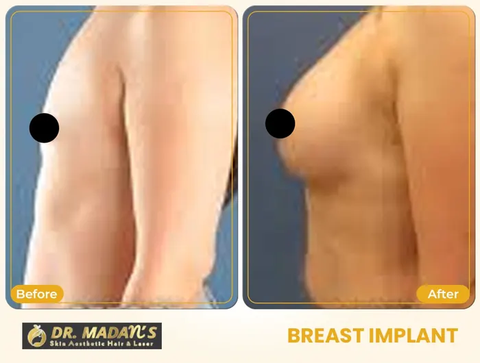 Breast implant before and after result 5 at Dr Madan Aesthetics